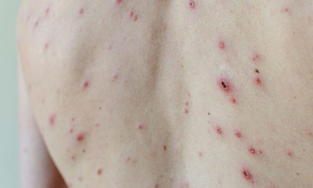 Get your children the chickenpox jab to stop the anti-vaxxers, minister tells parents ahead of NHS rollout