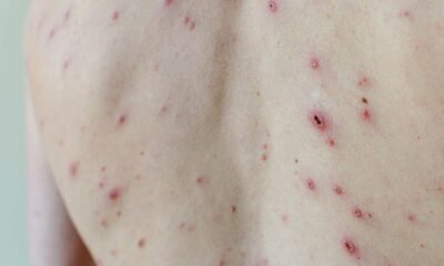 Get your children the chickenpox jab to stop the anti-vaxxers, minister tells parents ahead of NHS rollout