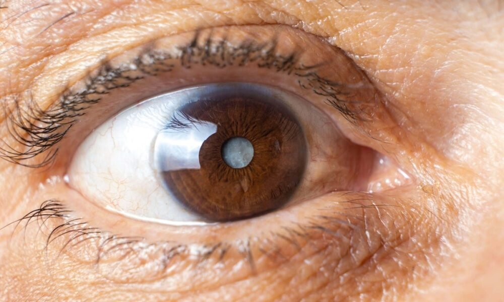 Study finds double cataract surgery is better for patients