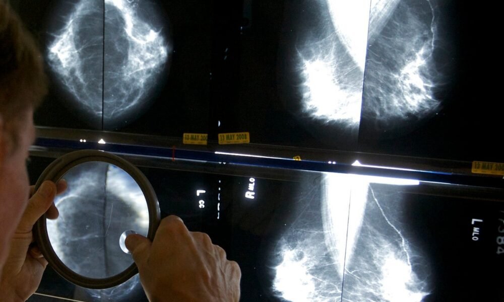 Cost of breast cancer to UK economy set to increase further