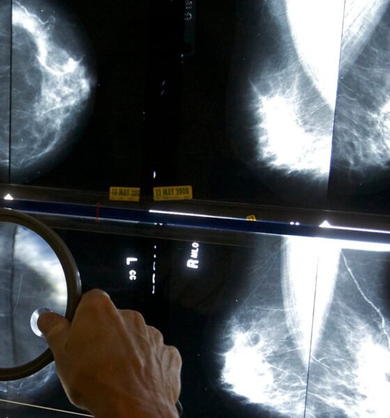 Cost of breast cancer to UK economy set to increase further