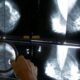 Cost of breast cancer to UK economy set to increase further