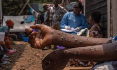 How an Mpox outbreak revealed an epidemic of untreated HIV in Sierra Leone – as Trump’s aid cuts begin to bite
