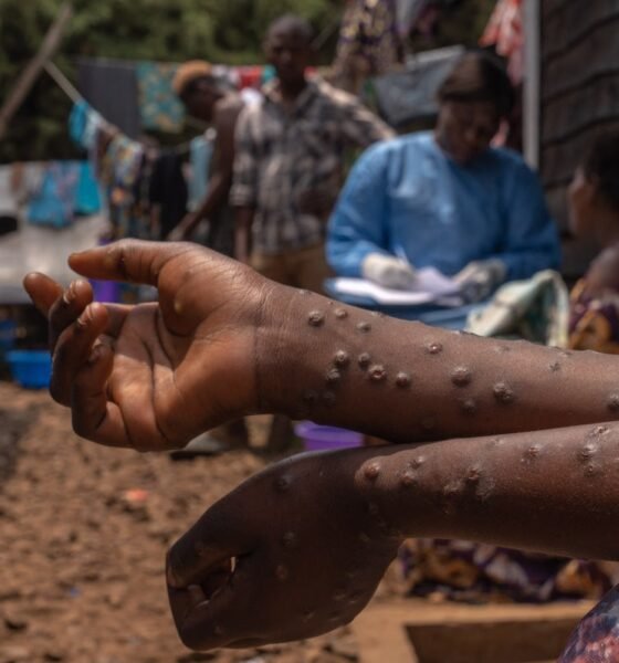 How an Mpox outbreak revealed an epidemic of untreated HIV in Sierra Leone – as Trump’s aid cuts begin to bite