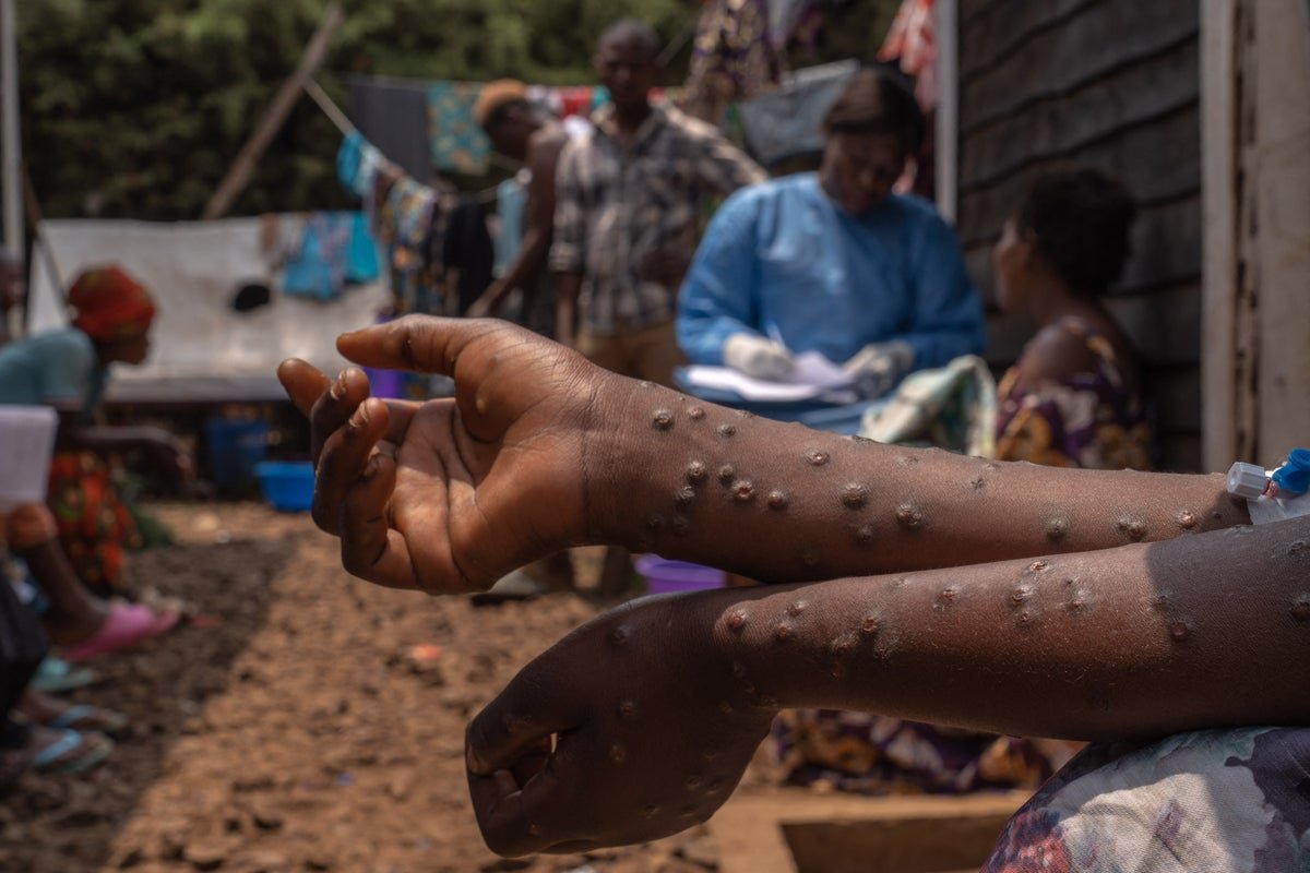 How an Mpox outbreak revealed an epidemic of untreated HIV in Sierra Leone – as Trump’s aid cuts begin to bite