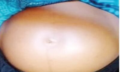 Struggling with a Big Belly But No Baby? Discover the Untold Struggles of Fibroids Affecting Nigerian Women!