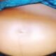 Struggling with a Big Belly But No Baby? Discover the Untold Struggles of Fibroids Affecting Nigerian Women!