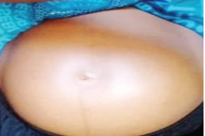 Struggling with a Big Belly But No Baby? Discover the Untold Struggles of Fibroids Affecting Nigerian Women!