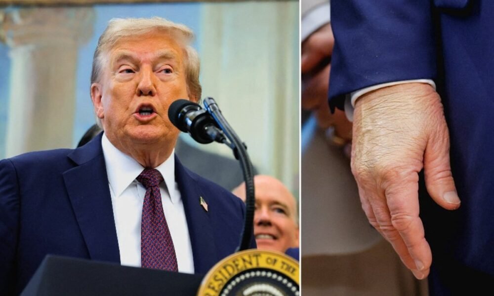 Trump blames the ‘so fake’ media for health rumors - but still sports a bruised hand in first appearance in days