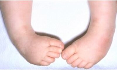 Unbelievable Impact: Foundation Transforms Lives of 91 Children with Clubfoot!