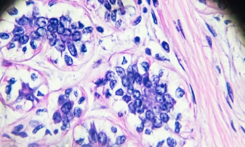 Researchers discover two genetic variants linked to breast cancer
