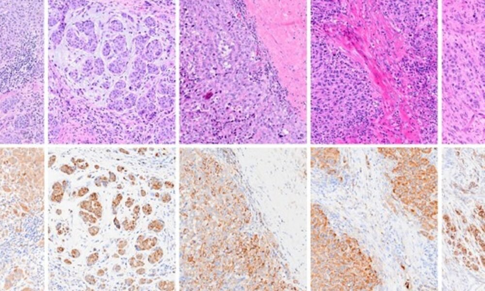 Groundbreaking ‘super vaccine’ could stop cancer from spreading entirely