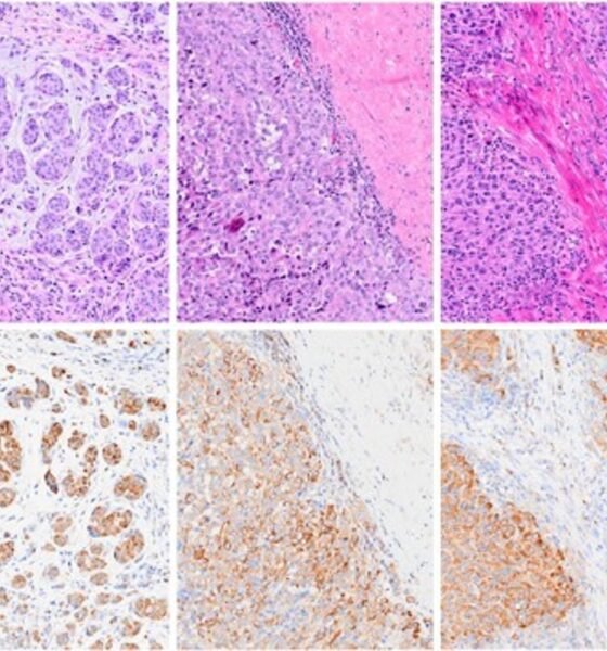 Groundbreaking ‘super vaccine’ could stop cancer from spreading entirely